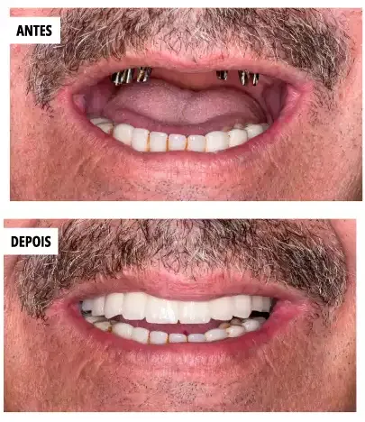 Prótese fixa sobre implantes